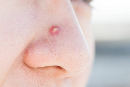 痤疮鼻子图片
