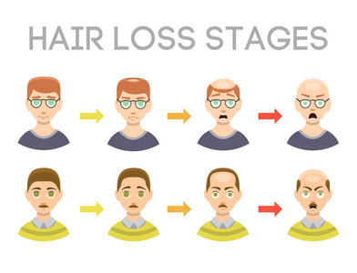 信息图表的脱发阶段类型的秃头男头矢量图所示