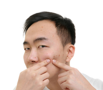 人类男性痤疮脸用放大镜男性面部皮肤问题男性 ace 与痤疮问题皮肤长