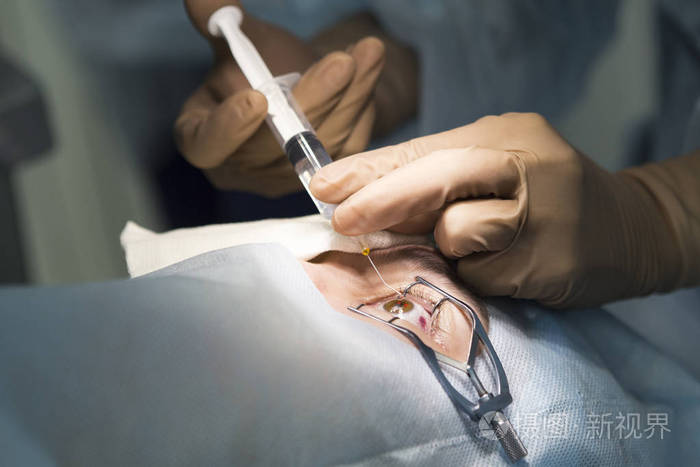 激光手术治疗视力矫正和白内障摘除术