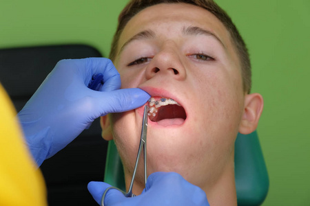 青少年牙异常闭塞症的治疗
