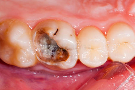 龋图片-龋素材-龋插画-摄图新视界