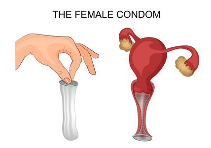 女用避孕套 子宫 