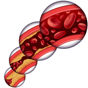冠状动脉胆固醇治疗的医学概念作为静脉从堵塞的动脉和动脉粥样硬化逐渐清除, 与一个3d 人体解剖学图减少胆固醇积累