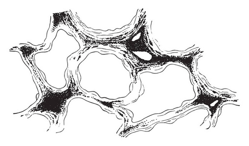 用煤尘 Anthracosis复古刻插图显示肺泡壁结缔组织浸润的肺段