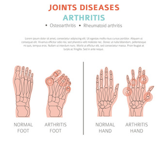 关节疾病。关节炎症状, 治疗图标设置。医疗图表设计。矢量插图