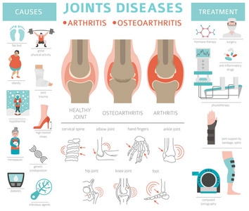 关节疾病。关节炎, 骨关节炎症状, 治疗图标设置。医疗图表设计。矢量插图