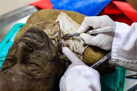 法医学头颈部的法医学解剖解剖照片