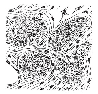 Encephaloid 癌, 复古雕刻插图