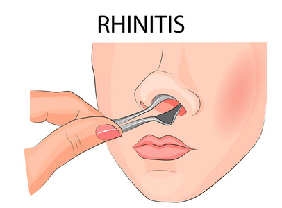 鼻腔内的检验