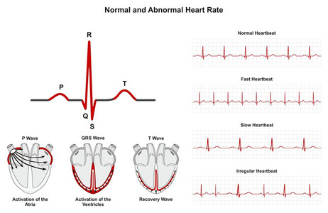 正常和异常心率图表图包括心房心室活化和恢复波也正常快速慢不规则心跳的图表为医学教育和医疗保健