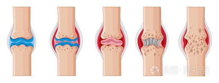 类风湿关节炎的人体关节
