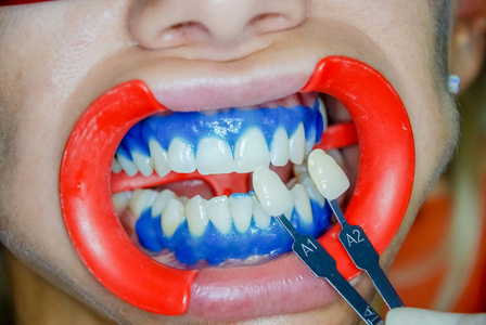 牙医比较患者的牙荫与样品为漂白治疗.健康的牙齿美白.