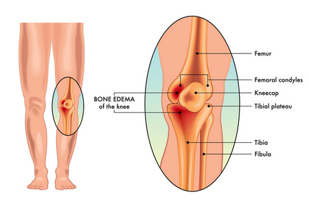 膝部医学海报骨水肿