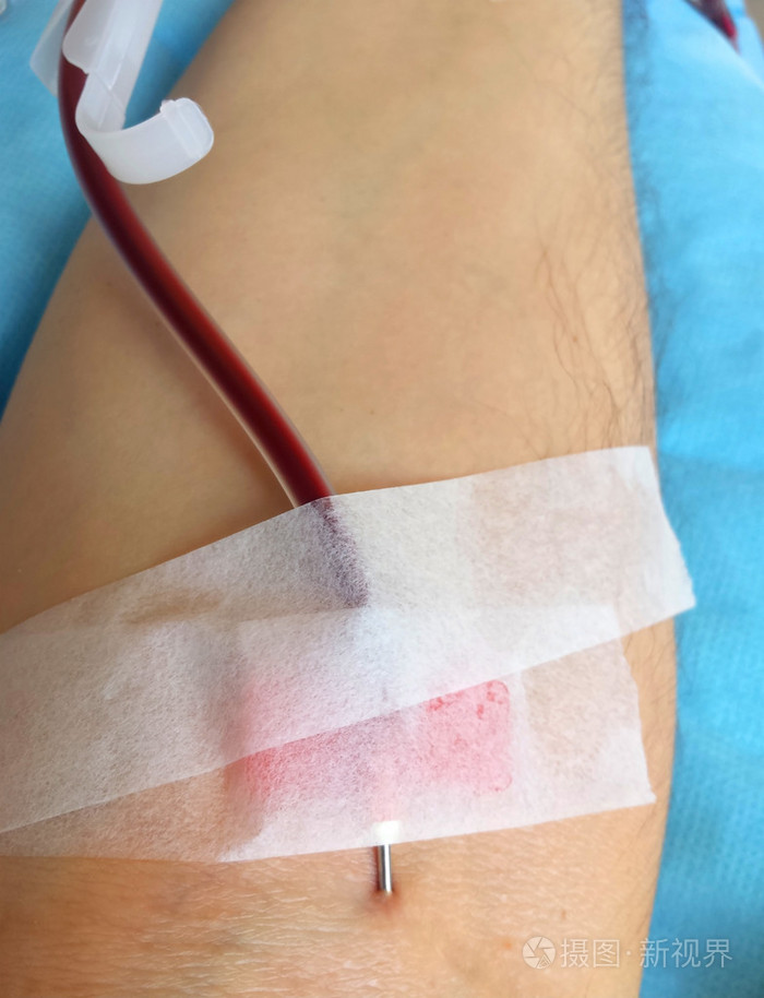 献血时针卡在手臂上照片-正版商用图片0s3ows-摄图新视界