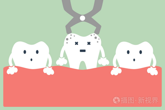 拔牙钳