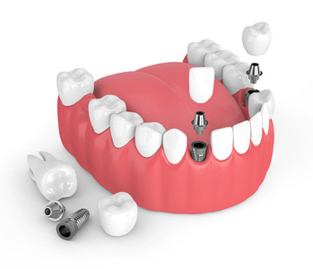 3d. 用牙科植入物在白色背景下进行颌骨渲染