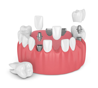 3d. 用牙科植入物和桥在白色背景下的下巴渲染
