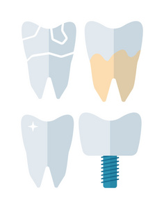 牙种植体矢量图示