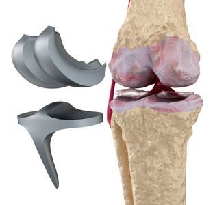 膝关节和钛的铰链联合。在白色隔离