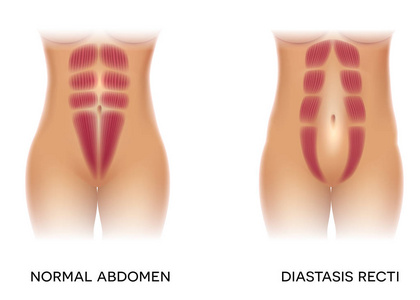 分离 recti 也称为腹部分离, 在孕妇中很常见。腹直肌肌间有间隙