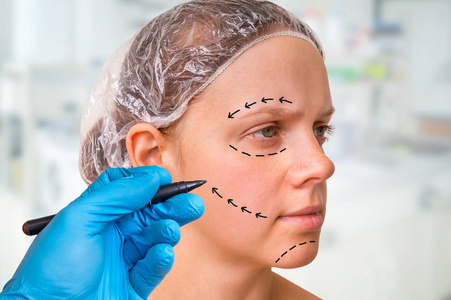 医生用记号笔在面部整形外科诊所的病人的脸上绘制线条