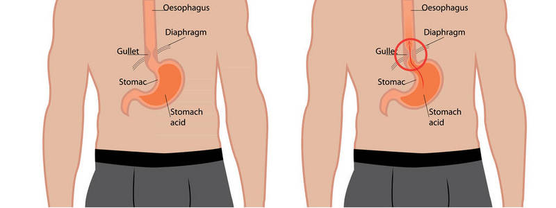 胃食管反流病。人体内胃食管反流的矢量图解