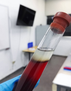 设备上的人血液透析从人体血液中提取简单 dna 的玻璃试管, 在大学