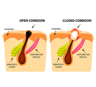 痤疮的类型。开放粉刺, 闭合粉刺, 皮肤结构。图表.独立背景上的矢量插图
