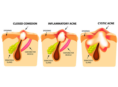 痤疮的类型。闭合粉刺, 炎性痤疮, 囊性痤疮。皮肤的结构。图表.独立背景上的矢量插图