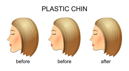 整形手术前后的 chin.before