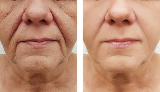 老年妇女脸上的皱纹, 前后的程序