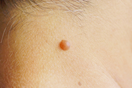 协管瘤白种人皮肤乳头状瘤照片