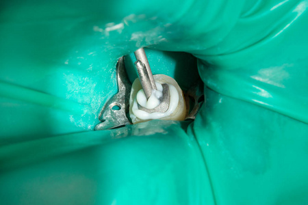 牙齿特写的牙髓治疗。牙齿根部的清洁和填充。牙科诊所的现代技术理念