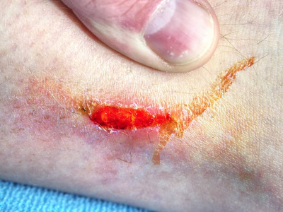 医生手医治血淋淋的区域.新鲜的磨损.皮肤深部伤口照片