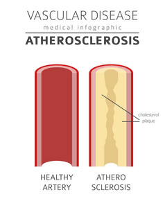 血管疾病。动脉粥样硬化症状, 治疗图标设置。医疗图表设计。矢量插图