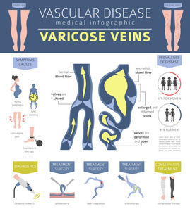 血管疾病。静脉曲张症状, 治疗图标设置。医疗图表设计。矢量插图