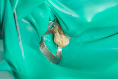 在牙科诊所的治疗阶段, 一个人腐烂的龋齿牙齿的特写。橡胶坝系统与乳胶围巾和金属夹的使用, photopolymeric 复合填料