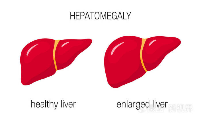 肿大概念.卡通风格的健康与扩大肝脏的矢量例证