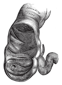此图表示盲肠显示回盲阀复古线图或雕刻插图