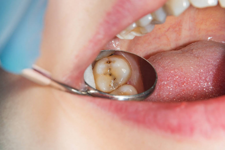 在牙科诊所的治疗阶段, 一个人腐烂的龋齿牙齿的特写。橡胶坝系统与乳胶围巾和金属夹的使用, photopolymeric 复合填料