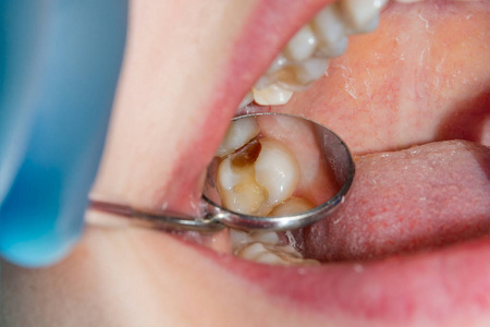 龋齿的阶段在牙科诊所的治疗阶段, 一个人腐烂的龋齿牙齿的特写.