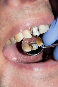 牙管在下磨牙恒牙磨牙中的应用与先端定位器的牙髓锉, 用围堰附着在其上的牙齿