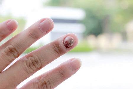 真菌指甲感染和人的手损伤。手指与甲真菌病