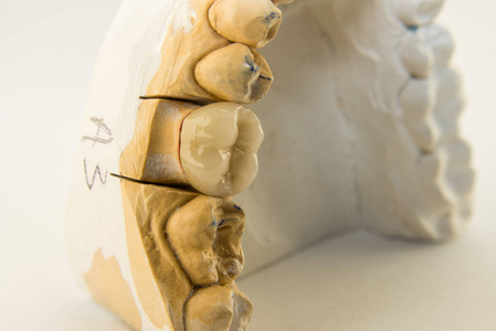 陶瓷瓷冠。制作牙齿的瓷冠。牙科诊所的假肢概念