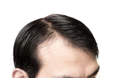 特写的年轻人严重脱发问题的头发损失概念