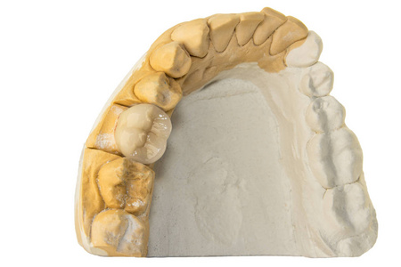 牙冠在人的下巴石膏模型。牙齿解剖冠制造过程的宏观特写。牙牙修复的概念