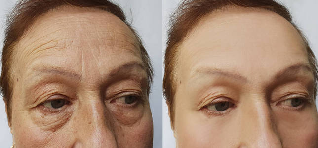 老年妇女在手术前后面部皱纹照片