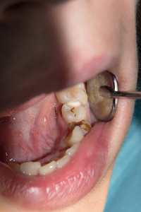 儿童根管治疗图片