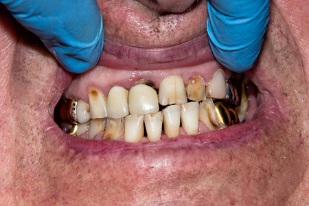 人牙龋病的治疗。用复合材料修复牙齿牙齿的概念